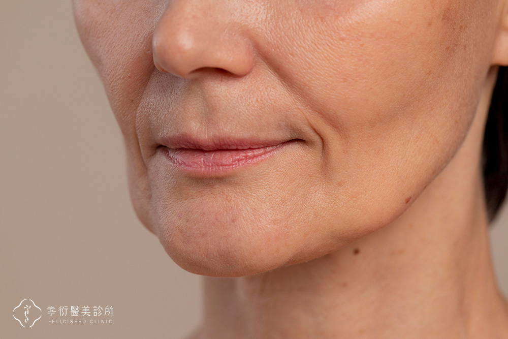口周老化-嘴巴
