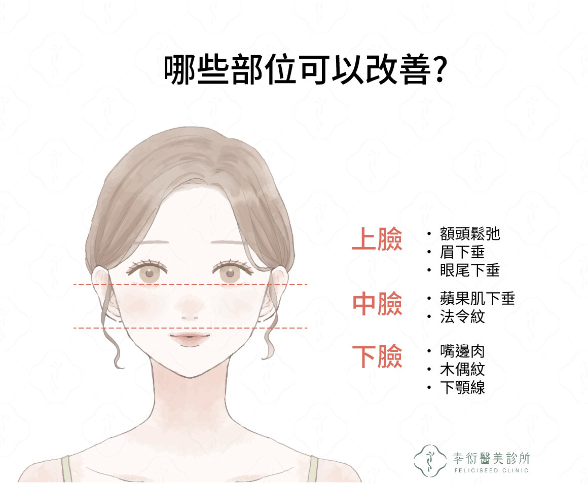 埋線拉提適用部位