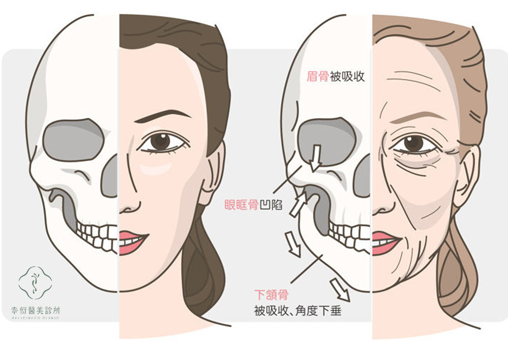 骨質老化:骨架隨著年齡出現吸收與內縮,特別是下顎骨、鼻基底與眼眶周圍,支撐力不足,導致臉部組織缺乏穩固基底,進一步加深鬆弛與下垂。
