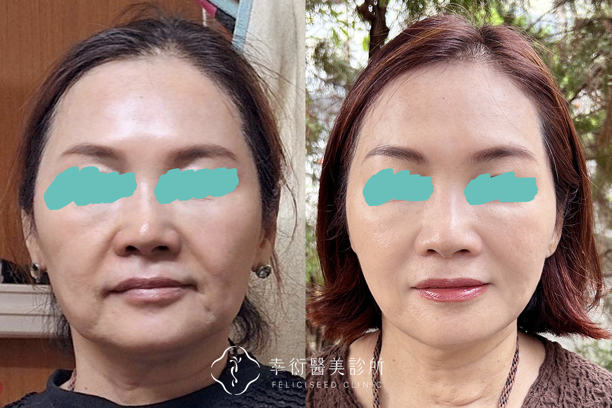 嘴周改善案例照02