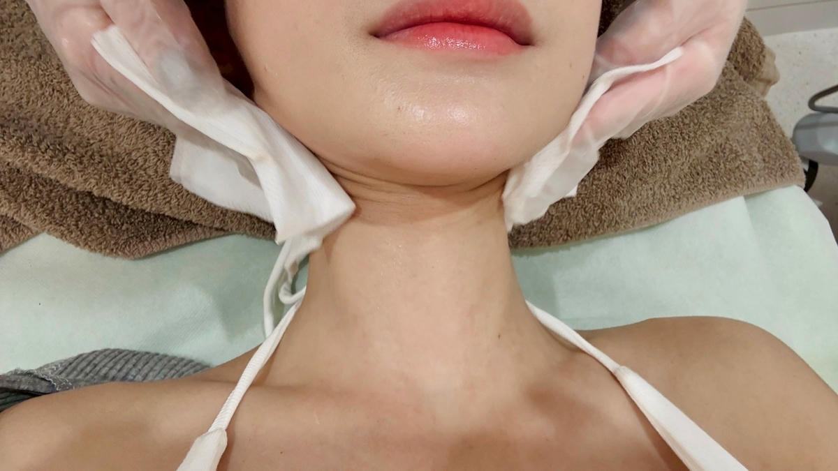 施打玻尿酸 volite