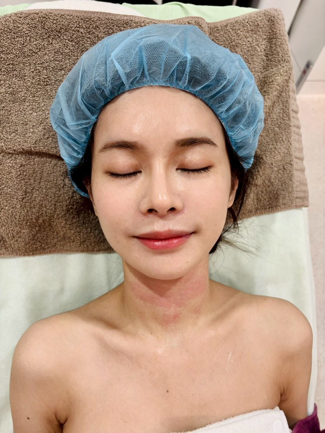 肌因煥膚針 volite 施打當下