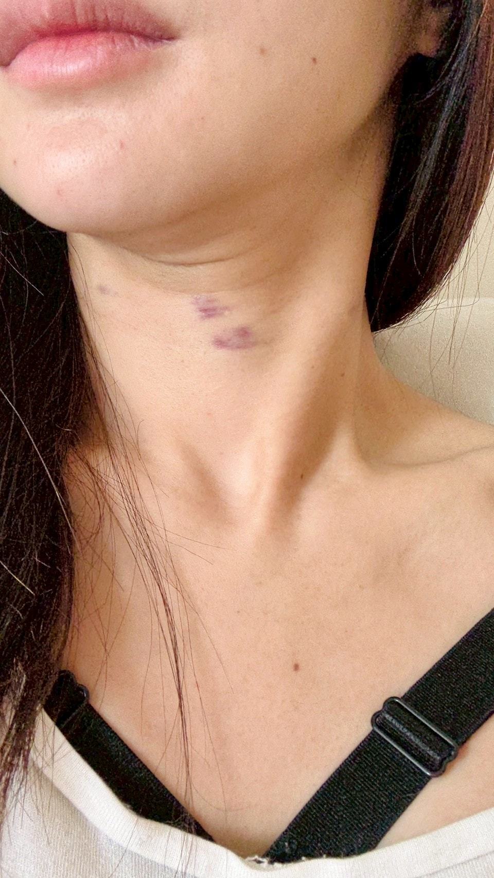 肌因煥膚針 volite 施打隔天狀況