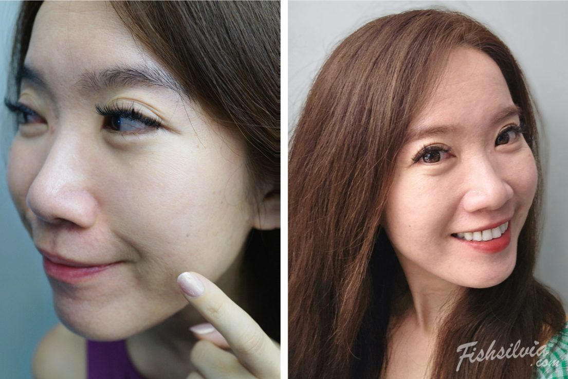 心動光+梭時雷射 術後第二天